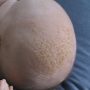 Kopf eines Neugeborenen mit Milchschorf